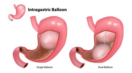 Intragastric Balloon Procedure